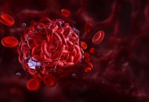 Tromboza: cauze, simptome, diagnosticare și tratament